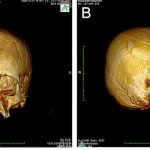 People’s Skulls Were Deformed Intentionally In Croatia 1500 Years Ago – RankRed